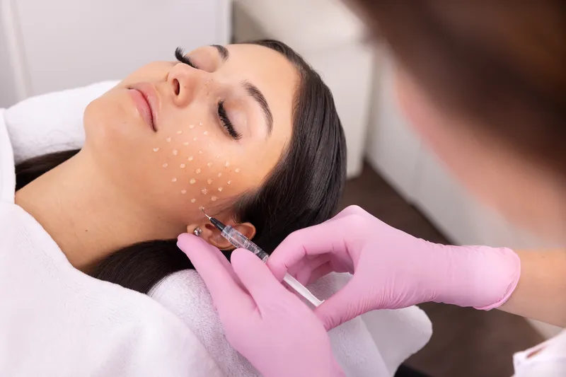 Mesotherapie-Behandlung im Gesichtsbereich
